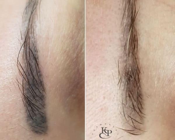 Синие брови после удаления или высветления ремувером приобретают более теплый оттенок
и становятся на два тона светлее