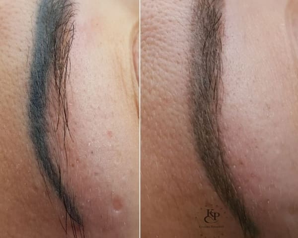 Высветление удаление синих бровей. После процесса высветления старого татуажа бровей
брови светлеют и их можно перекрыть другим пигментом