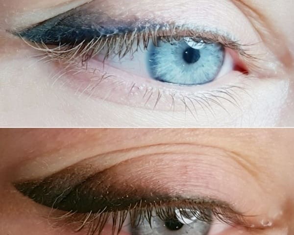 Синий татуаж век можно исправить при помощи ремувера и перекрытия новым пигментом