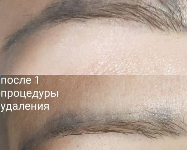 Удаление высветление старого татуажа. Синие брови после татуажа или микроблейдинга
высветляются ремувером